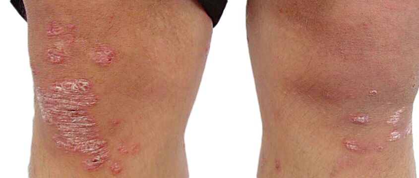 Psoriasis is an unpleasant skin disease that requires treatment with Keraderm cream