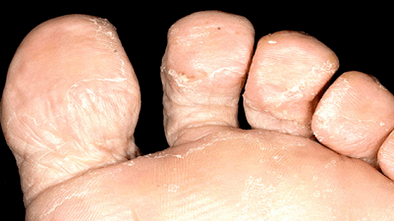 How to recognize the presence of a mushroom between the fingers of the feet