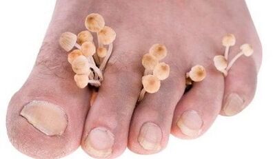 The reasons for the development of the mushroom between the fingers of the feet
