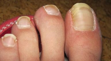 How the mushroom on the nails is manifested