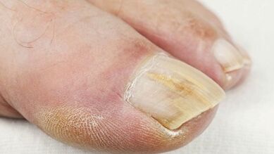 The initial phase of the development of the mushroom on the nails