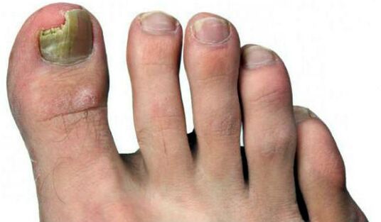 Crushing of the nail
