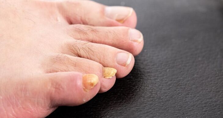 yellowing of nails due to foot fungus
