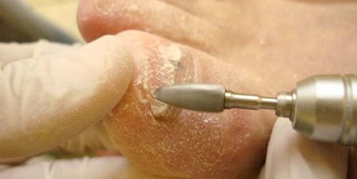 fungal nail removal