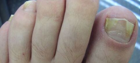symptoms of fungus on the nail and its treatment with vinegar