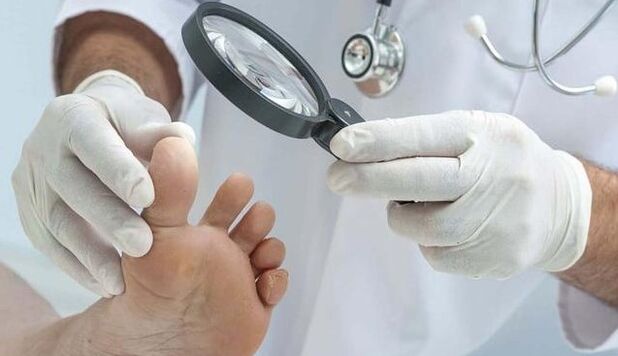 Fungal diagnosis
