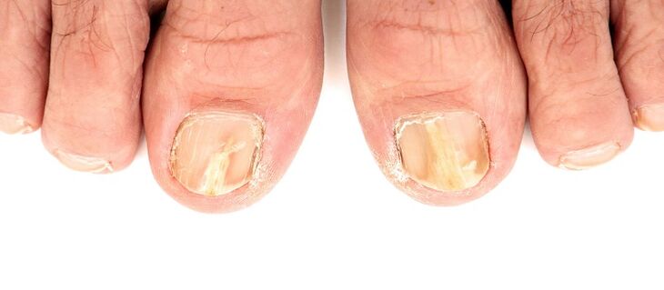 damage to the nail plate with fungus
