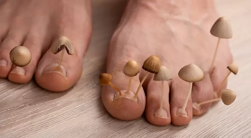 Fungal infection affecting toenails