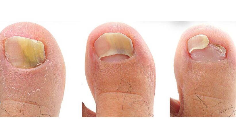 types of toenail fungi