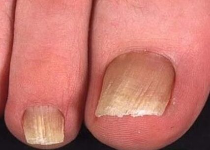 Nail mushroom on the legs of the initial phase