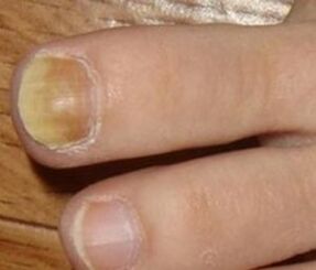Symptoms of the initial phase of the nail fungus